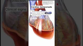 Cardiac tamponade [upl. by Fahy440]