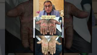 Psoriasis on Palm of Hands Effective Homeopathic Treatment [upl. by Akenet]