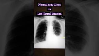 Normal xray vs Pleural Effusion 🩻 🫁 medical xray disease radiology infection shorts [upl. by Ardehs]