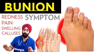 What is Bunion  क्या होता है Hallux valgus  DrEducation [upl. by Ahseinod283]