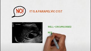 Renal cyst ultrasound POCUS pearls and pitfalls by Dr Koratala NephroP [upl. by Pentheam]