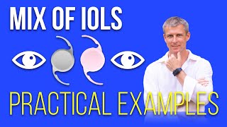 Mixing IOLs for better vision outcomes  practical examples [upl. by Anura]