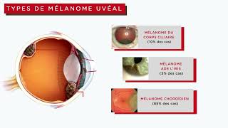 Mieux Comprendre Le Mélanome de Luvée Guide à LIntention Des Patients [upl. by Odnala420]