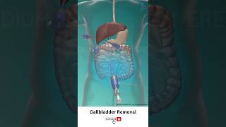 Gallbladder Removal Surgery ↪ 3D Medical Animation Shorts Gallbladder [upl. by Gayleen]