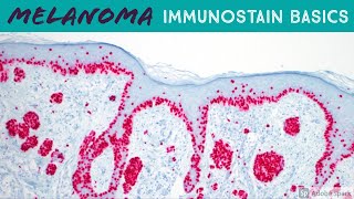 Melanoma Immunohistochemistry Basics Melanoma In Situ vs Solar Lentigo  5Minute Pathology Pearls [upl. by Einal]