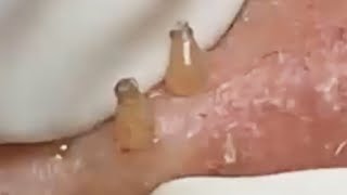 Extraction profonde des points noirs Acné kystique et popping 28 [upl. by Maddis]