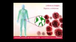 Canceres Comunes del Sistema Linfatico [upl. by Worth433]