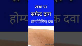 vitiligo cream homeopathic medicine leucoderma cream homeopathy सफेद दाग ammi visnaga shortvideos [upl. by Vaios]