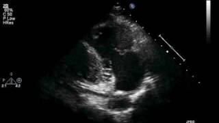 Transthoracic ECHO Parasternal Long RV Inflow View [upl. by Kcirdlek]