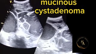 Ultrasound Imaging mucinous Cystadenoma [upl. by Retha999]