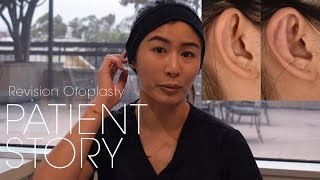 Revision Otoplasty For Prominent Ear Correction  Ear Fold Surgery Patient Testimonial [upl. by Pigeon]