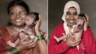 Baby Girl With Covered In Hair Has Familys Rare Gene [upl. by Acimehs]