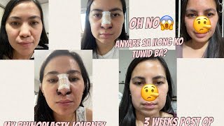 MY RHINOPLASTY JOURNEY PHILIPPINES 3 weeks post op [upl. by Doane]