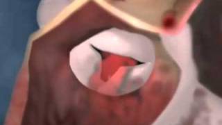 Aortic Valve Stenosis 3D Video on Healthline com [upl. by Itirahc703]