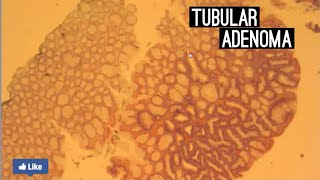 Tubular Adenoma [upl. by Neumark329]