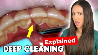 Dental Hygienist Explains Deep Cleaning Procedure [upl. by Ohl485]