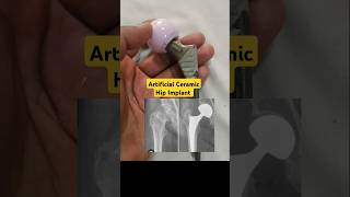 Artificial Ceramic Hip for Damaged Hip Joints🔥hipjointreplacement hipfracturerecovery [upl. by Ymeraj845]