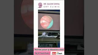 Watch What This Doctor Uncovers During Endoscopic Examination of a Childs Adenoid Hypertrophy [upl. by Annayram475]