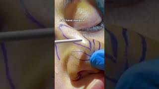 RHINOPLASTY STEPBYSTEP DR TANVEER JANJUA NEW JERSEY [upl. by Coats356]