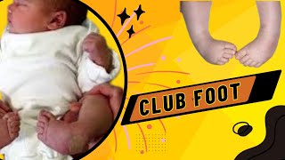 Talipes Equinovarus  Club Foot  Causes Symptoms Diagnosis and Treatment [upl. by Nuawed979]