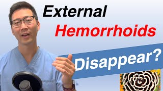 Can External hemorrhoids go away on their own Does treatment matter [upl. by Riamo]