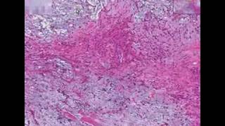 Histopathology Salivary glandPleomorphic adenoma mixed tu [upl. by Leiba844]