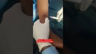 ARS Dog bite vaccine medical doctors anti rabies serum youtubeshorts [upl. by Trin]