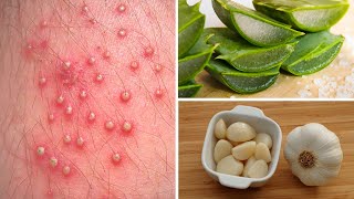 7 Powerful Home Remedies to Get Rid of Folliculitis [upl. by Savannah393]