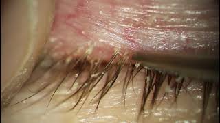 Demodex Blepharitis Eyelash Debriding  Thick Lashes [upl. by Cassandre]