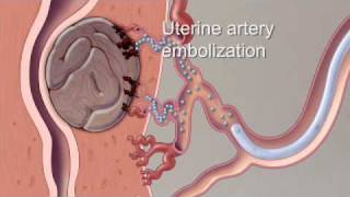 Fibroid Treatment Options  Mayo Clinic [upl. by Eidurt171]