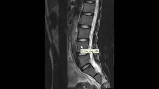 Pars defects of the lumbar spine [upl. by Ecyarg924]