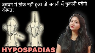 HYPOSPADIAS  बचपन में ठीक नहीं हुआ तो जवानी में चुकानी पड़ेगी कीमत [upl. by Lozano]