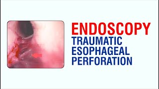 Endoscopy Traumatic Esophageal Perforation  Best Gastroenterologist Doctor in Patna [upl. by Latisha]