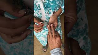 satisfying toenailfungus ingrowntoenailsurgery pedicure toenails nails [upl. by Reginnej]