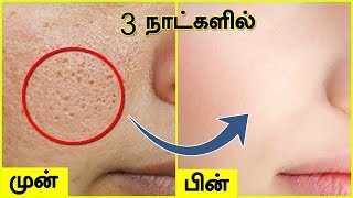 முகத்தில் உள்ள சிறுசிறு குழிகள் OPEN PORES மறைய  Open Large Pores on Face [upl. by Aenat]