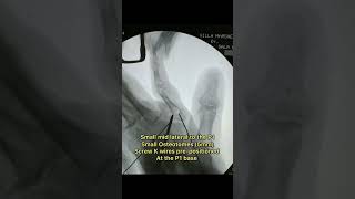 Miniinvasive proximal Phalanx Malunion Corrective Osteotomy [upl. by Snoddy]