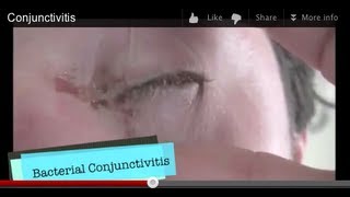 Conjunctivitis [upl. by Nesilla]