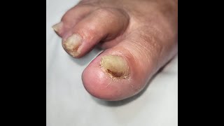 Thin a CURLED THICK toenail DEEP CLEANING with a nail that just keeps on giving nailtutorial [upl. by Orpheus569]