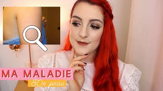 Ma maladie de peau  je vous dis tout 😫 Kératose Pilaire amp mes conseils   LOdoesmakeup [upl. by Orazio]