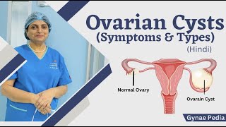 What are Ovarian Cysts Symptoms and Types  क्या है ओवेरियन सिस्ट  Hindi  Dr Neera Bhan [upl. by Eelyak]