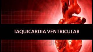 Arritmias cardíacas  Taquicardia ventricular [upl. by Eusadnilem588]