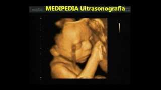 MEDIPEDIA Ultrassonografia Feto 7 meses 3D4D Real time [upl. by Asilaj800]