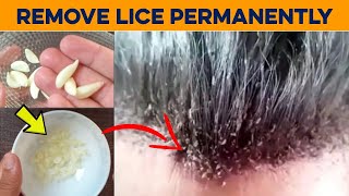 How to Get Rid of Lice Permanently in 1 Hour  Home Remedies to Get Rid of Lice Eggs in Hair [upl. by Ees]