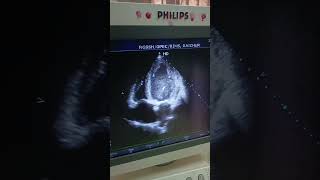 2D ECHO  EF 38  LV GLOBAL HYPOKINESIA DILATED LV LA RA [upl. by James856]