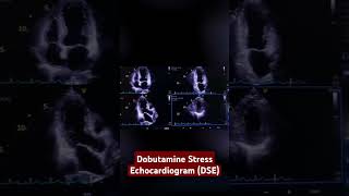 dobutamine stress echocardiogram DSE [upl. by Reinhart655]