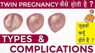 Twins Pregnancy Types Dichorionic Conjoined Monochorionic Diamniotic Monochorionic Monoamniotic [upl. by Trixi]