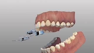 Rapid Palatal Expander [upl. by Doner]