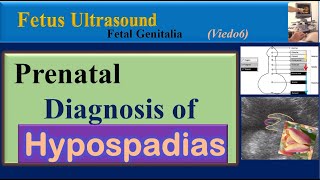 Fetus Ultrasound Prenatal Diagnosis of Hypospadias [upl. by Cleasta782]