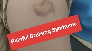 Painful Bruising Syndrome [upl. by Aisset]