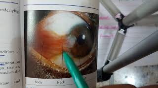 PTERYGIUM verry IMPORTANT conjuctival condition explanation with scenario [upl. by Yanehc]